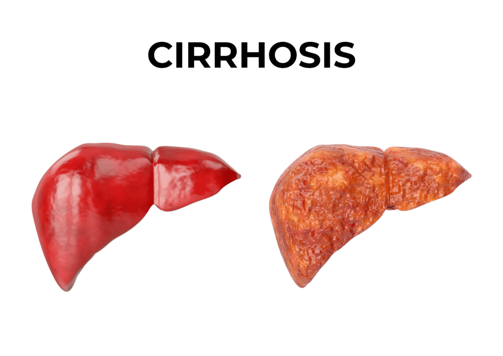 Liver Cirrhosis – एक Silent Killer जिसे नज़रअंदाज़ करना पड़ सकता है भारी